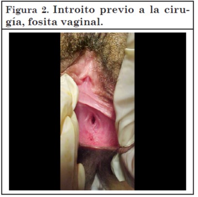 Vaginoplastia 02