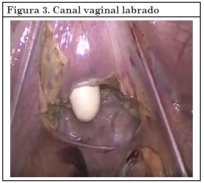Vaginoplastia 03